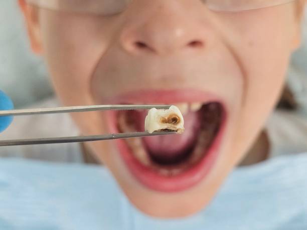 Best Emergency Tooth Extraction in Hudson, WI